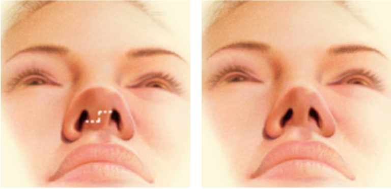 Complex Septoplasty With Valve Repair Nose Surgery Lonestar Surgery