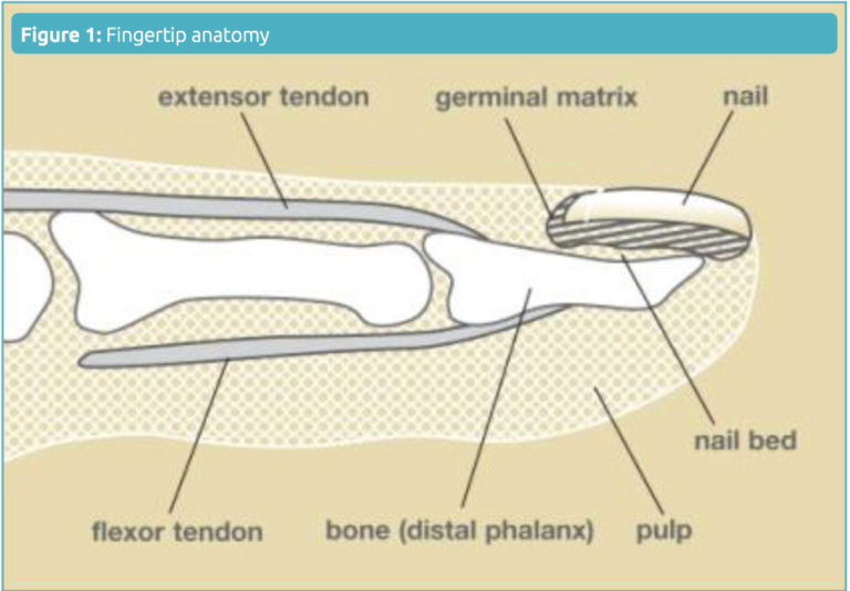 Revision Amputation Of Finger From Injury Trans Phalanx P2 Level ...