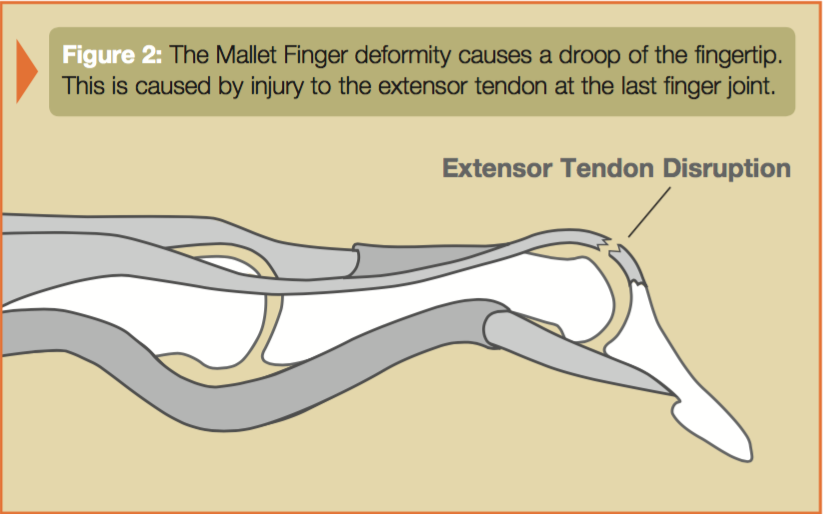 primary-tendon-repair-of-the-hand-extensor-index-long-ring-small