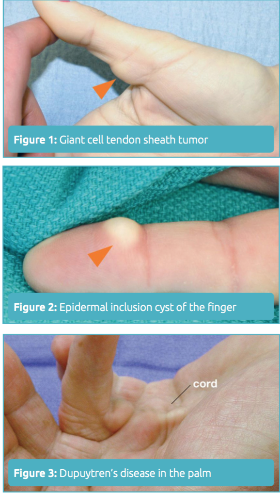 mass-excision-finger-hand-deep-hand-or-wrist-tumor-lonestar-surgery